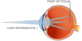 Laser Eye Surgery For Astigmatism And Eye Problems At Vista Eyes