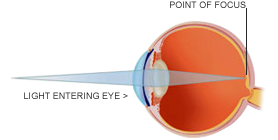 Laser Eye Surgery For Astigmatism and Eye Problems at Vista Eyes