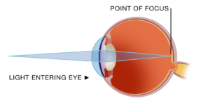 Eye Conditions & Refractive Errors Info | VISTA EYES Clinic